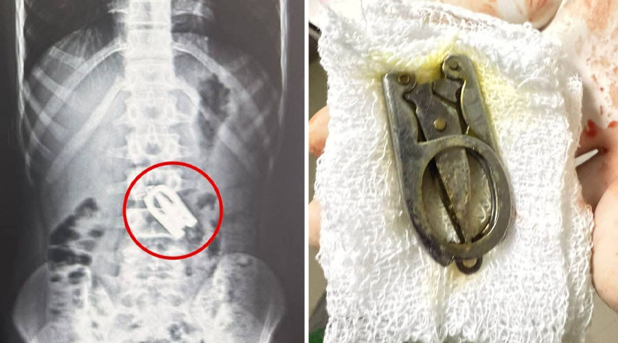 बालकको पेटमा अडकिएको कैंची निकालियो